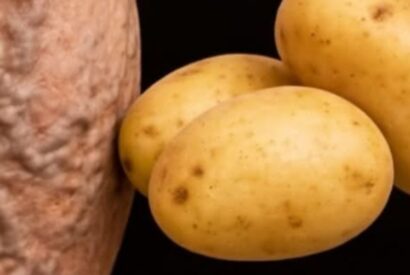 Thumbnail for Say Goodbye to Varicose Veins and Heavy Legs with a Natural Potato Remedy