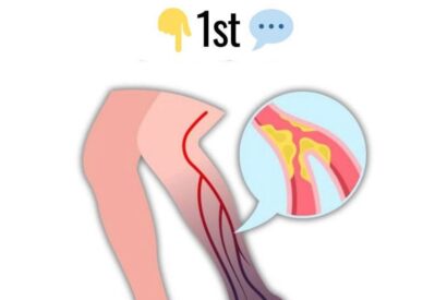 Thumbnail for 10 Warning Signs of a Blood Clot in the Leg You Should Know