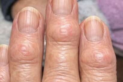 Thumbnail for Heberden’s Nodes: Why Hard Bumps Form on Finger Joints (A Guide to Hand Osteoarthritis)