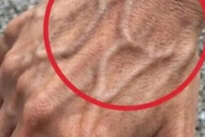 Thumbnail for If Someone Has Visible Veins, Does It Mean Their Circulation Is Poor?