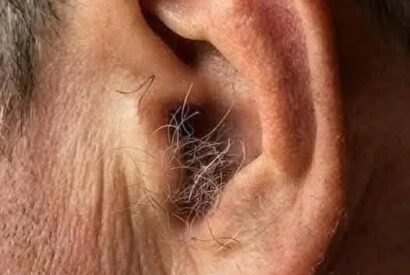 Thumbnail for What Your Ear Hair Says About Your Health: The “Frank’s Sign” Connection
